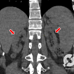 O lupus eritematoso sistêmico é uma doença autoimune que como o próprio nome diz, acomete vários órgãos, entre eles os rins, que desenvolvem uma glomerulonefrite. Os achados de imagem vão ser de uma doença renal crônica. Aqui vemos rins pequenos, com proeminência do tecido adiposo dos seios renais, achados que devem ser valorizados quando alguém apresenta insuficiência renal.